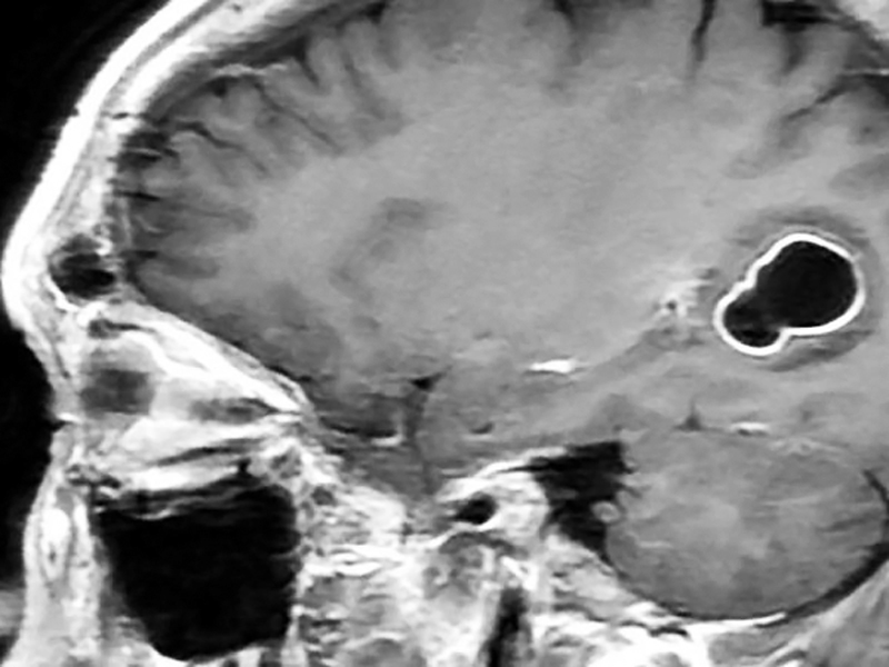 Encuentran larvas en el cerebro de hombre que comía carne de cerdo poco cocida